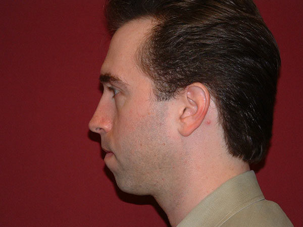 Chin Augmentation Patient 05 Before 1