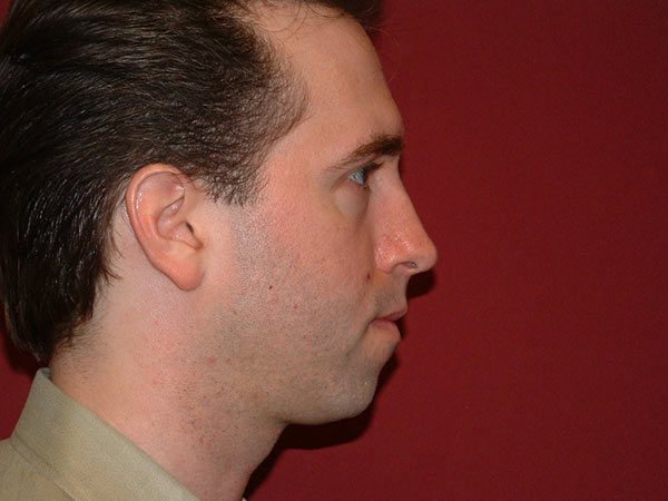 Chin Augmentation Patient 05 Before 2