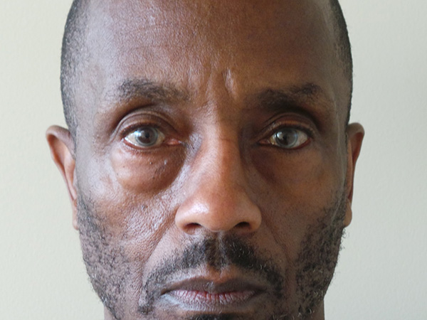 Eyelid Surgery Patient 23 Before 1