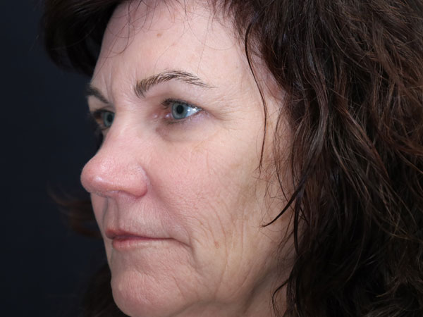 Eyelid Surgery Patient 24 Before 1