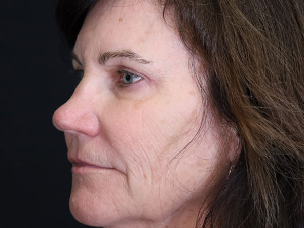 Eyelid Surgery Patient 24 After 1