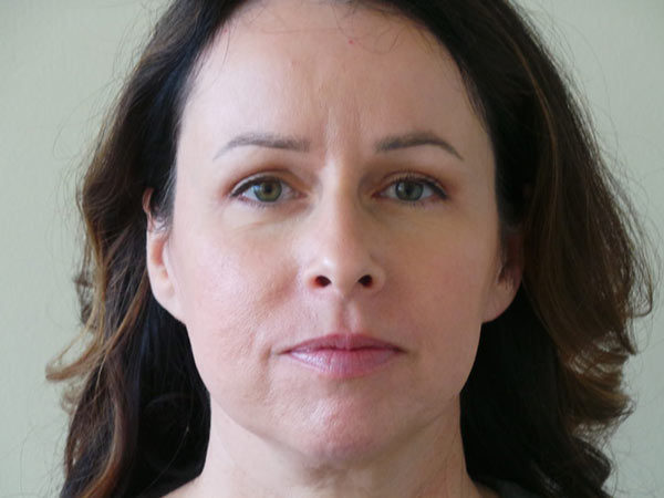 Eyelid Surgery Patient 01 After 1