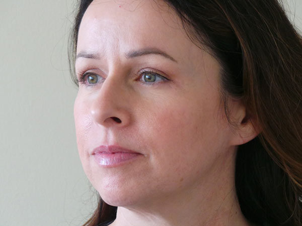 Eyelid Surgery Patient 01 After 2