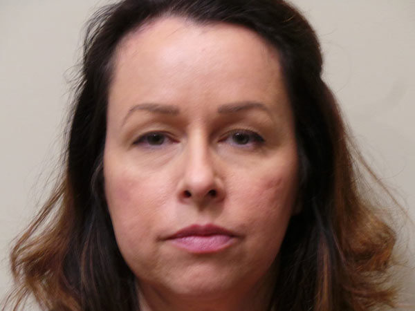 Eyelid Surgery Patient 01 Before 1