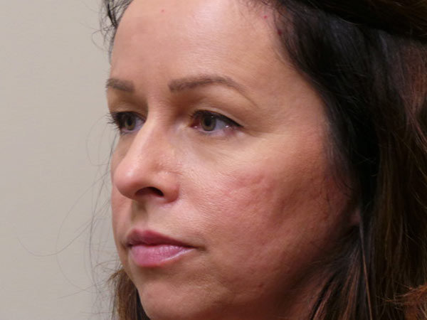 Eyelid Surgery Patient 01 Before 2