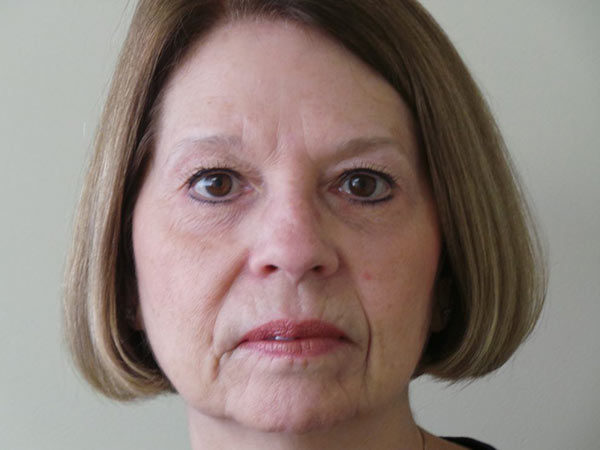 Eyelid Surgery Patient 10 After 1