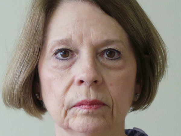 Eyelid Surgery Patient 10 Before 1