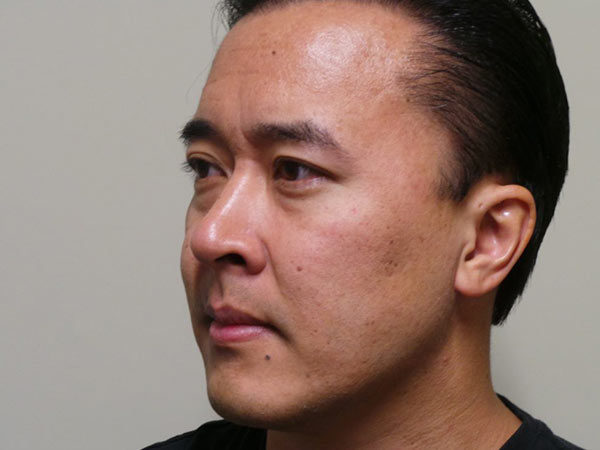 Eyelid Surgery Patient 14 Before 1