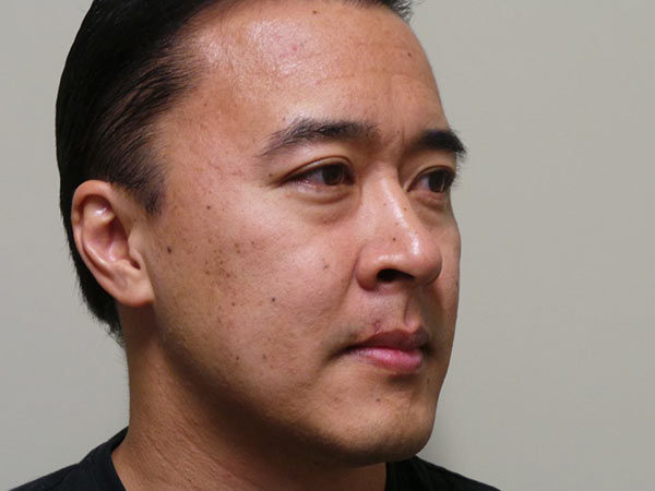 Eyelid Surgery Patient 14 Before 2