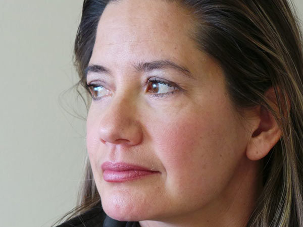 Eyelid Surgery Patient 16 After 2