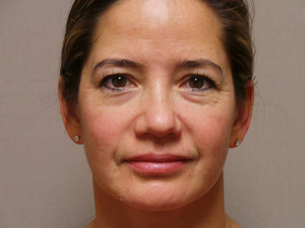 Eyelid Surgery Patient 16 Before 1