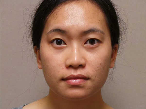 Eyelid Surgery Patient 18 After 1