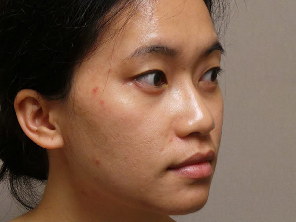 Eyelid Surgery Patient 18 After 2