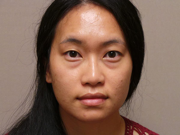 Eyelid Surgery Patient 18 Before 1