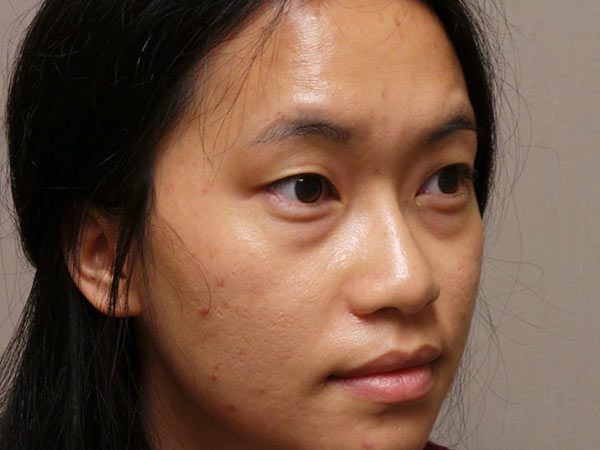 Eyelid Surgery Patient 18 Before 2