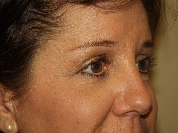 Eyelid Surgery Patient 20 After 2