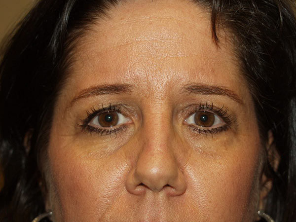 Eyelid Surgery Patient 20 Before 1