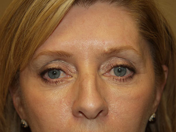 Eyelid Surgery Patient 21 After 1