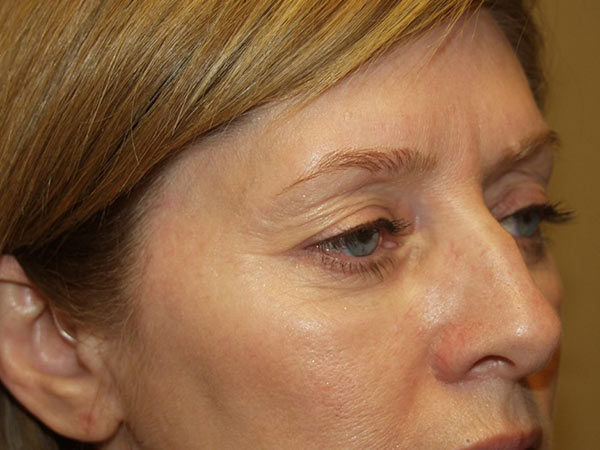 Eyelid Surgery Patient 21 Before 2