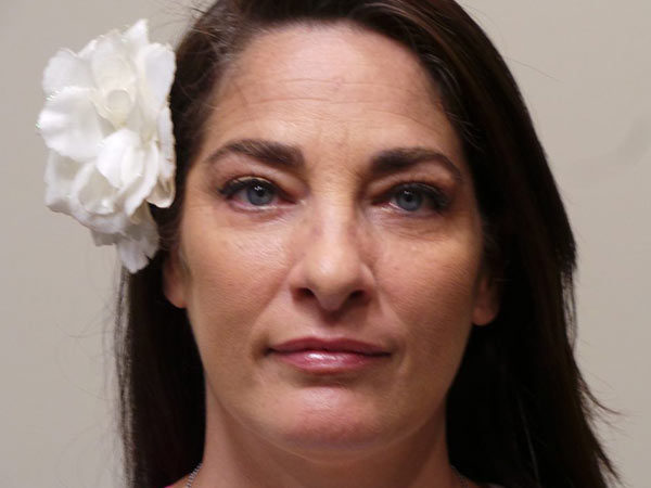 Eyelid Surgery Patient 11 After 1