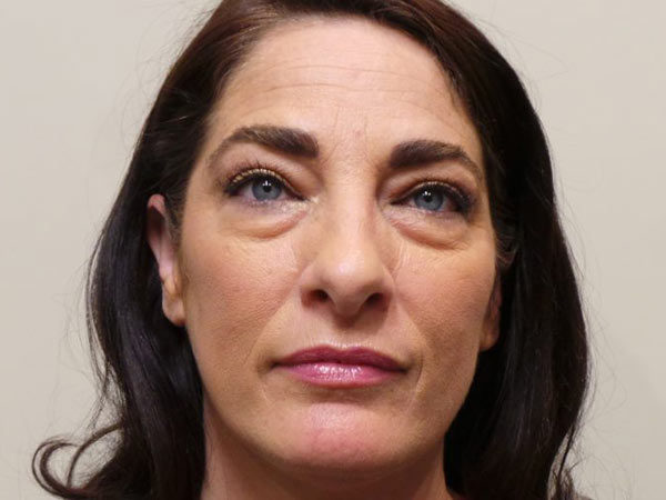 Eyelid Surgery Patient 11 Before 1