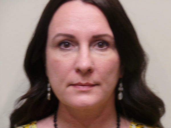 Eyelid Surgery Patient 02 After 1