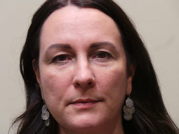 Eyelid Surgery Patient 02 Before 1