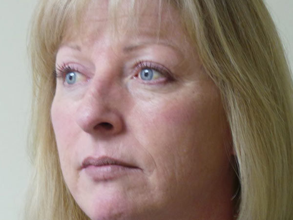 Eyelid Surgery Patient 17 After 1