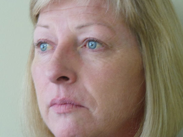 Eyelid Surgery Patient 17 Before 1