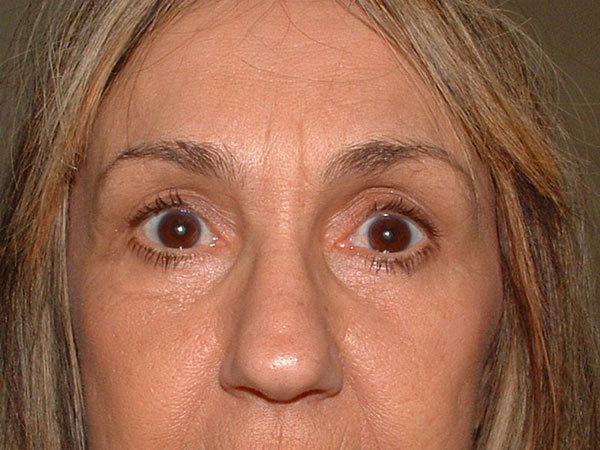 Eyelid Surgery Patient 19 After 1