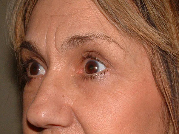 Eyelid Surgery Patient 19 After 2