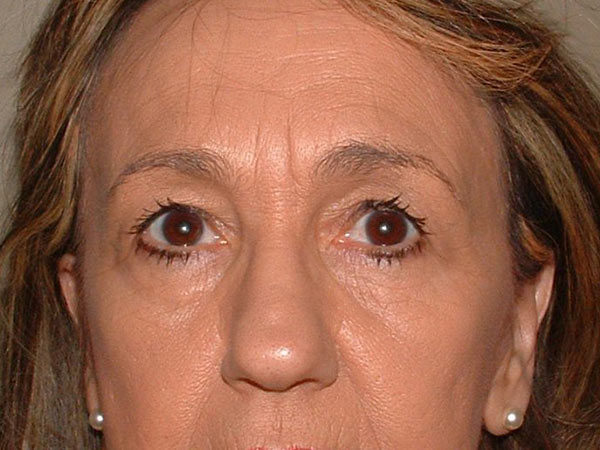 Eyelid Surgery Patient 19 Before 1