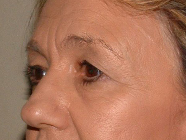 Eyelid Surgery Patient 19 Before 2