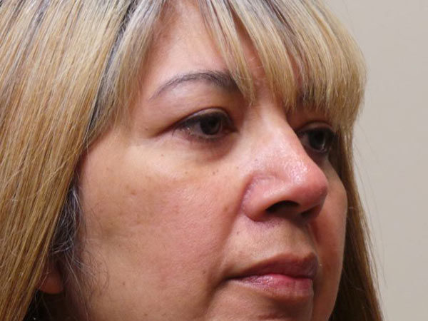 Eyelid Surgery Patient 03 After 2