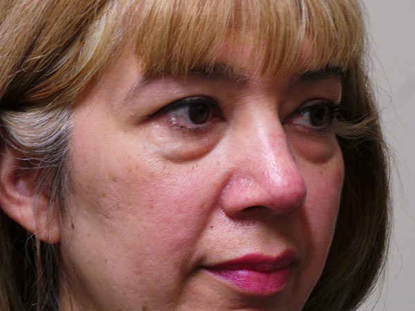 Eyelid Surgery Patient 03 Before 2