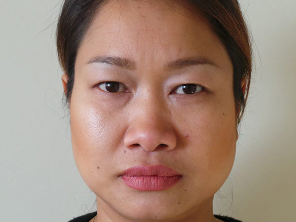 Eyelid Surgery Patient 04 Before 1