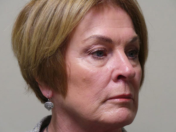 Eyelid Surgery Patient 05 Before 2