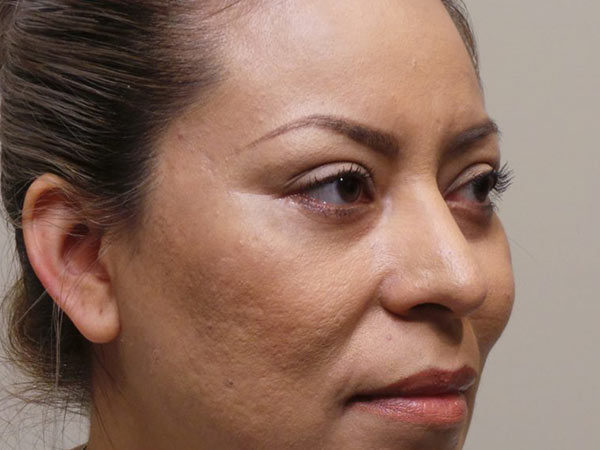 Eyelid Surgery Patient 06 After 2