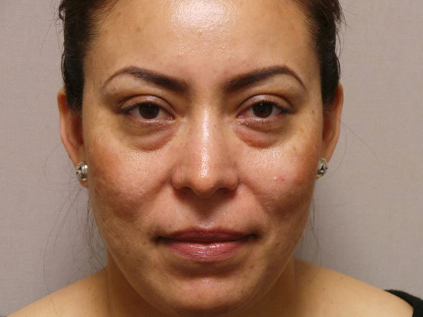 Eyelid Surgery Patient 06 Before 1