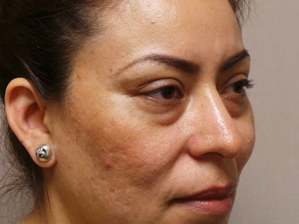 Eyelid Surgery Patient 06 Before 2