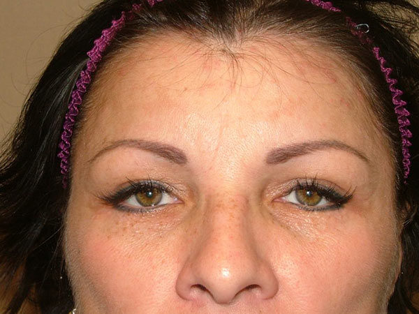 Eyelid Surgery Patient 07 After 1
