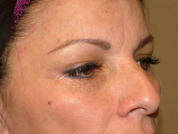 Eyelid Surgery Patient 07 After 2