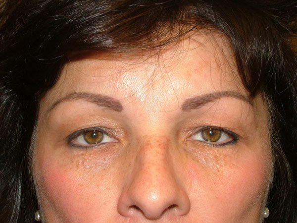 Eyelid Surgery Patient 07 Before 1