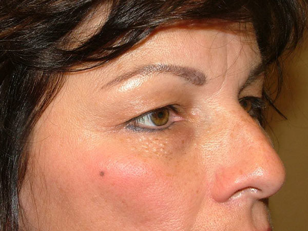 Eyelid Surgery Patient 07 Before 2
