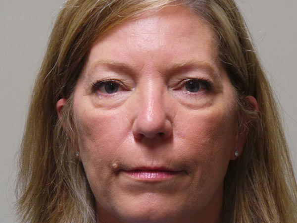 Eyelid Surgery Patient 09 Before 1