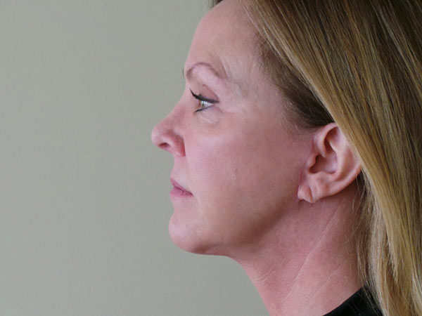 FaceLift Patient 01 After 2