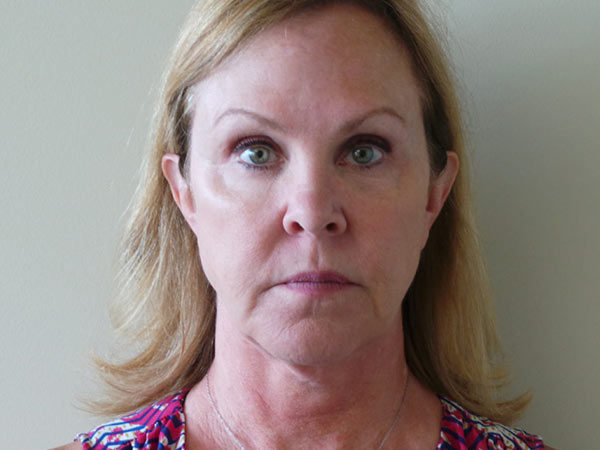 FaceLift Patient 01 Before 1