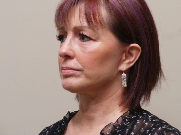 FaceLift Patient 02 After 1