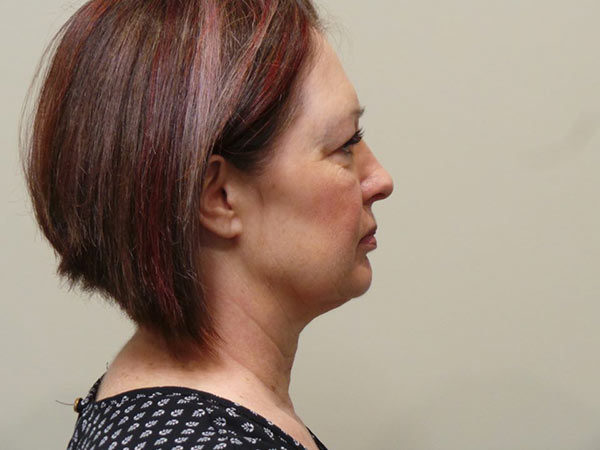 FaceLift Patient 02 Before 2