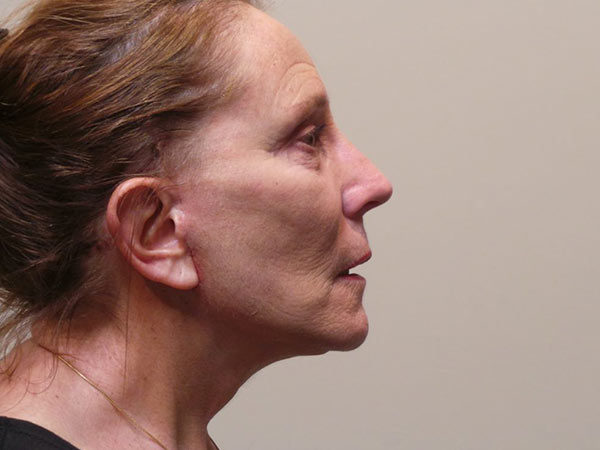 Facelift Patient 08 After 2